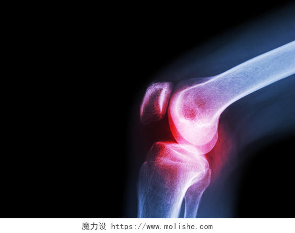 x 射线下的膝关节关节炎病症